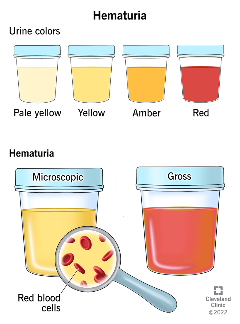 Illustration showing different colors of pee, including pale yellow, amber and red, and microscopic and gross hematuria