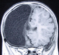 After right anatomic hemispherectomy, coronal MRI shows the absence of brain tissue on right side.