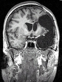 In left functional hemispherectomy, certain areas of the brain responsible for muscle movement are removed. 