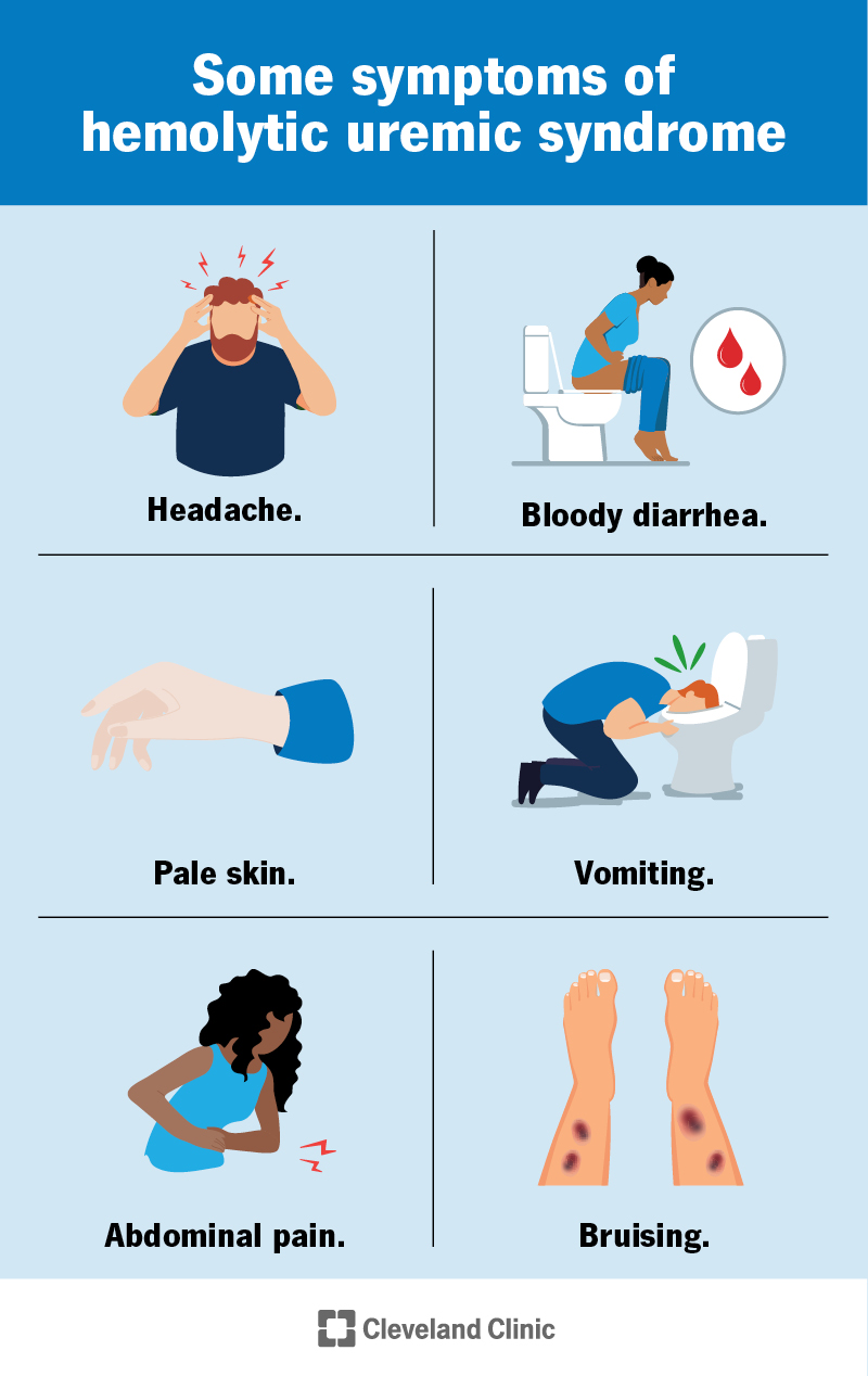 Hemolytic Uremic Syndrome (HUS): Symptoms & Treatment