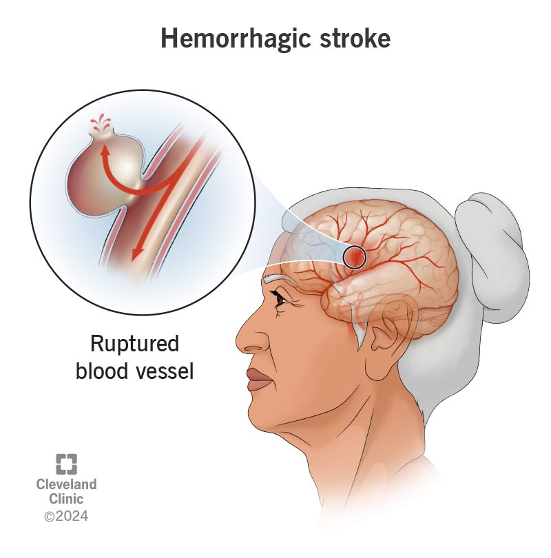 A hemorrhagic stroke, with a ruptured blood vessel in the brain of a person