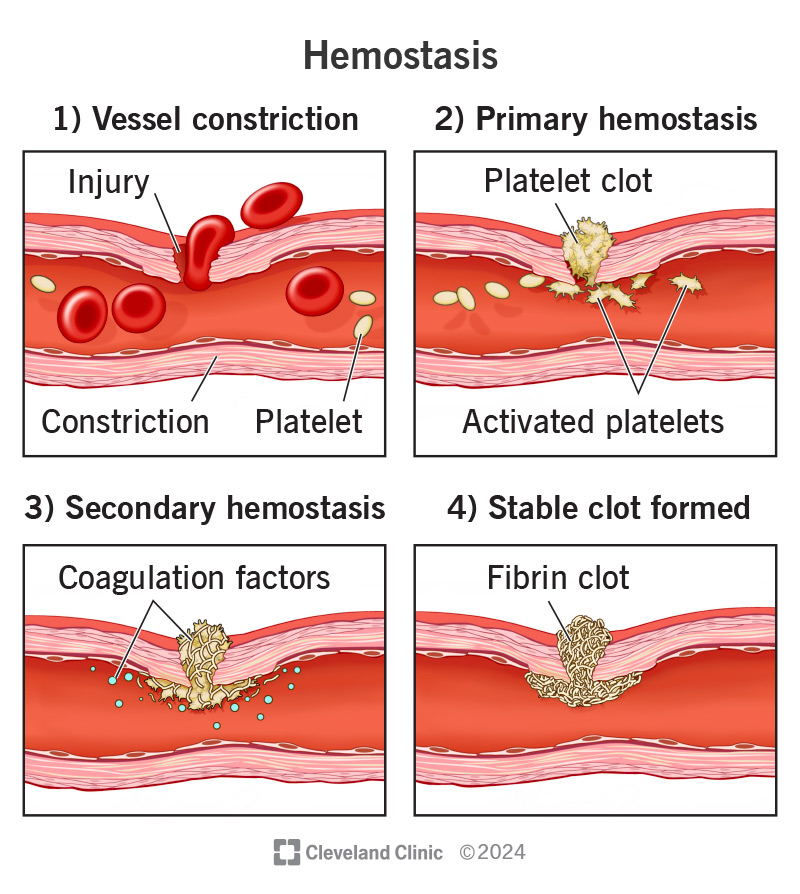 The hemostasis process has several steps. Your body makes a plug to stop the bleeding at the site of your injury.