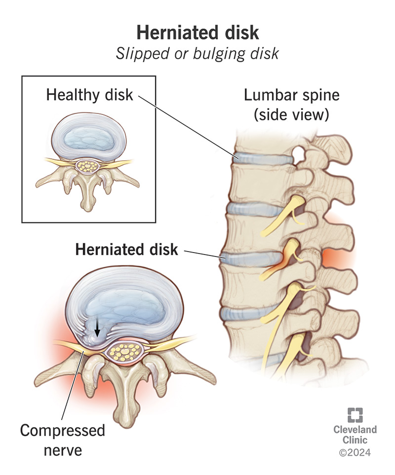 Comparing a healthy disk to a herniated disk in the spine