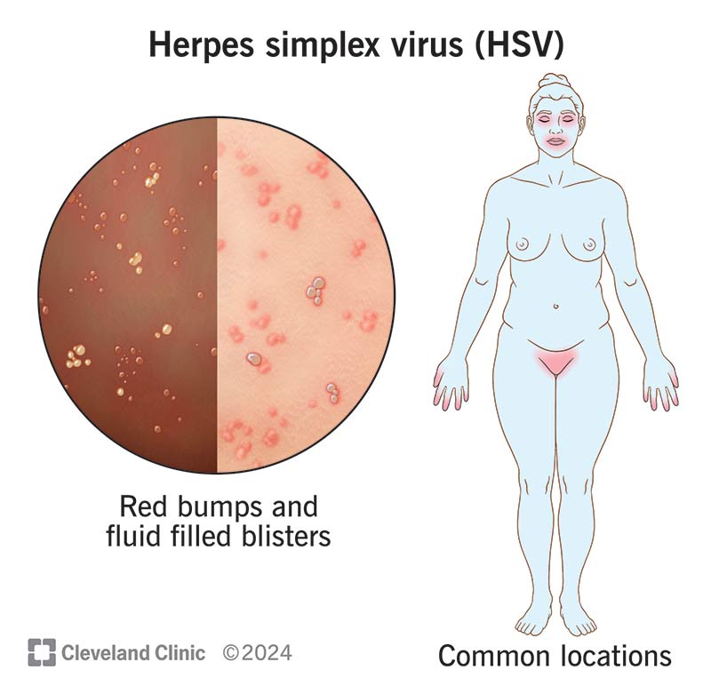 Herpes simplex virus (HSV) can infect many different parts of your body, causing bumps and fluid-filled blisters to appear