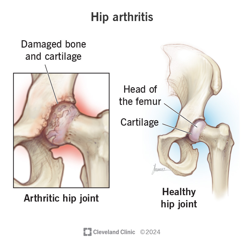 Damaged cartilage in the hip socket