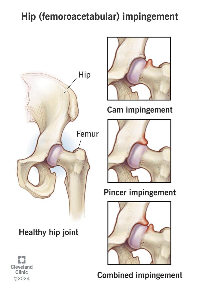 Healthy hip joint and examples of hip impingements: cam, pincer, combined