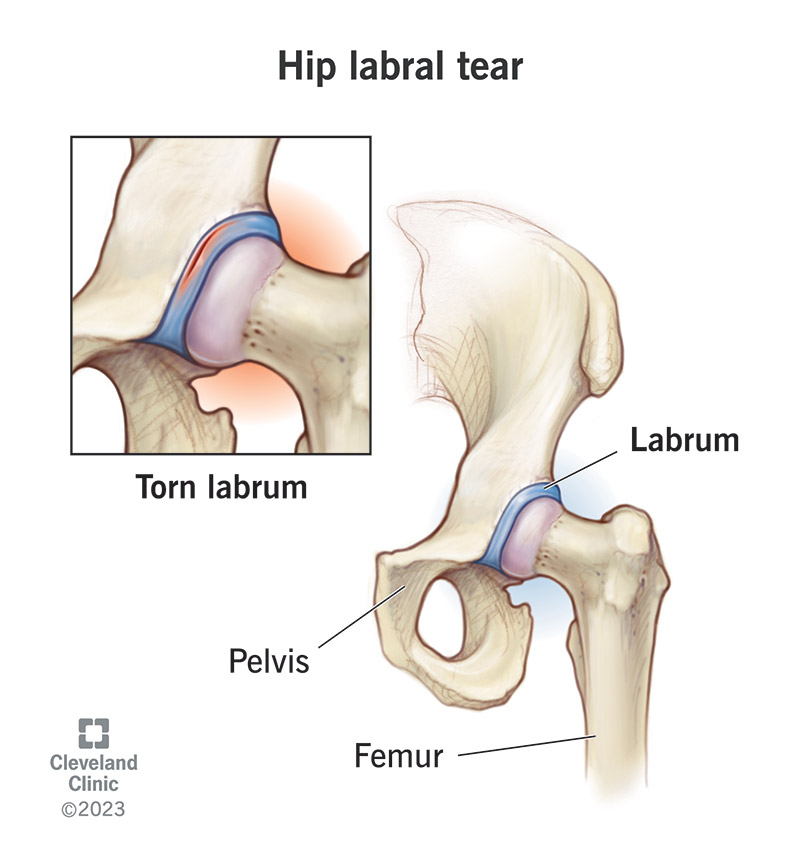 The hip labrum is a soft, protective lining in your hip socket. Tears cause pain and stiffness.
