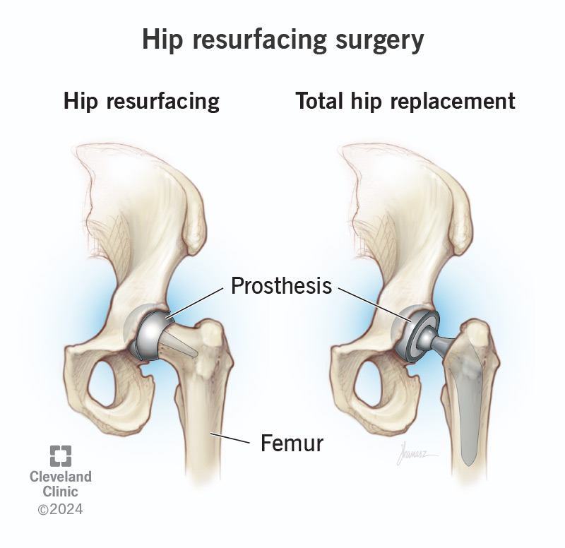 Hip resurfacing is surgery to repair damage inside your hip joint.