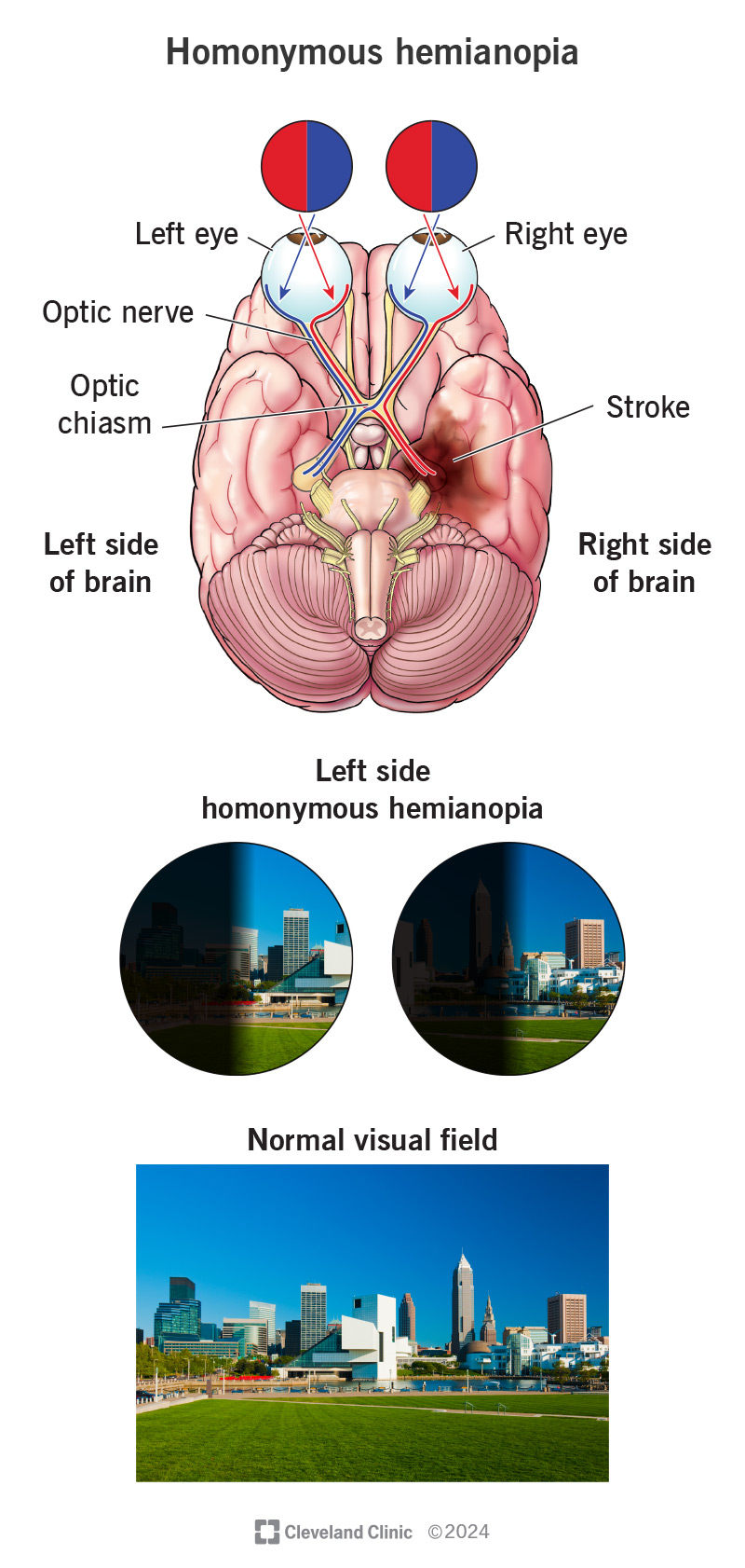 An infographic of how homonymous hemianopia causes vision loss on the same side of both eyes.