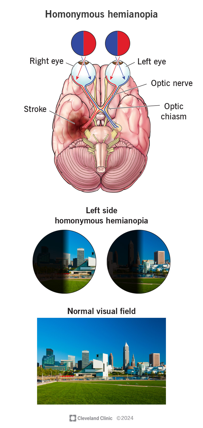 An infographic of how homonymous hemianopia causes vision loss on the same side of both eyes.