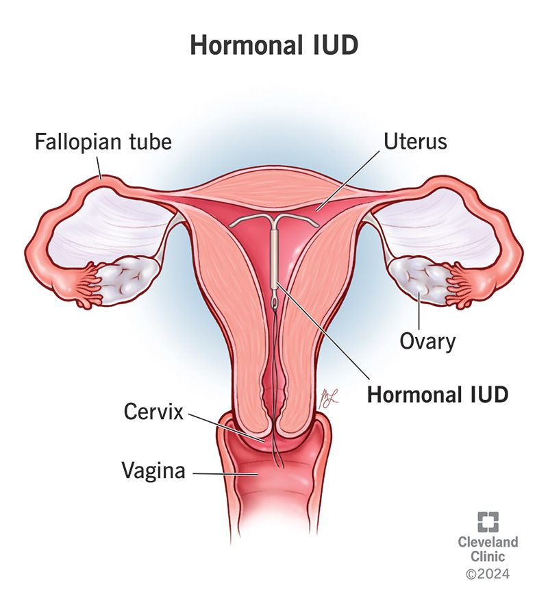 T-shaped hormonal IUD inside of a uterus.