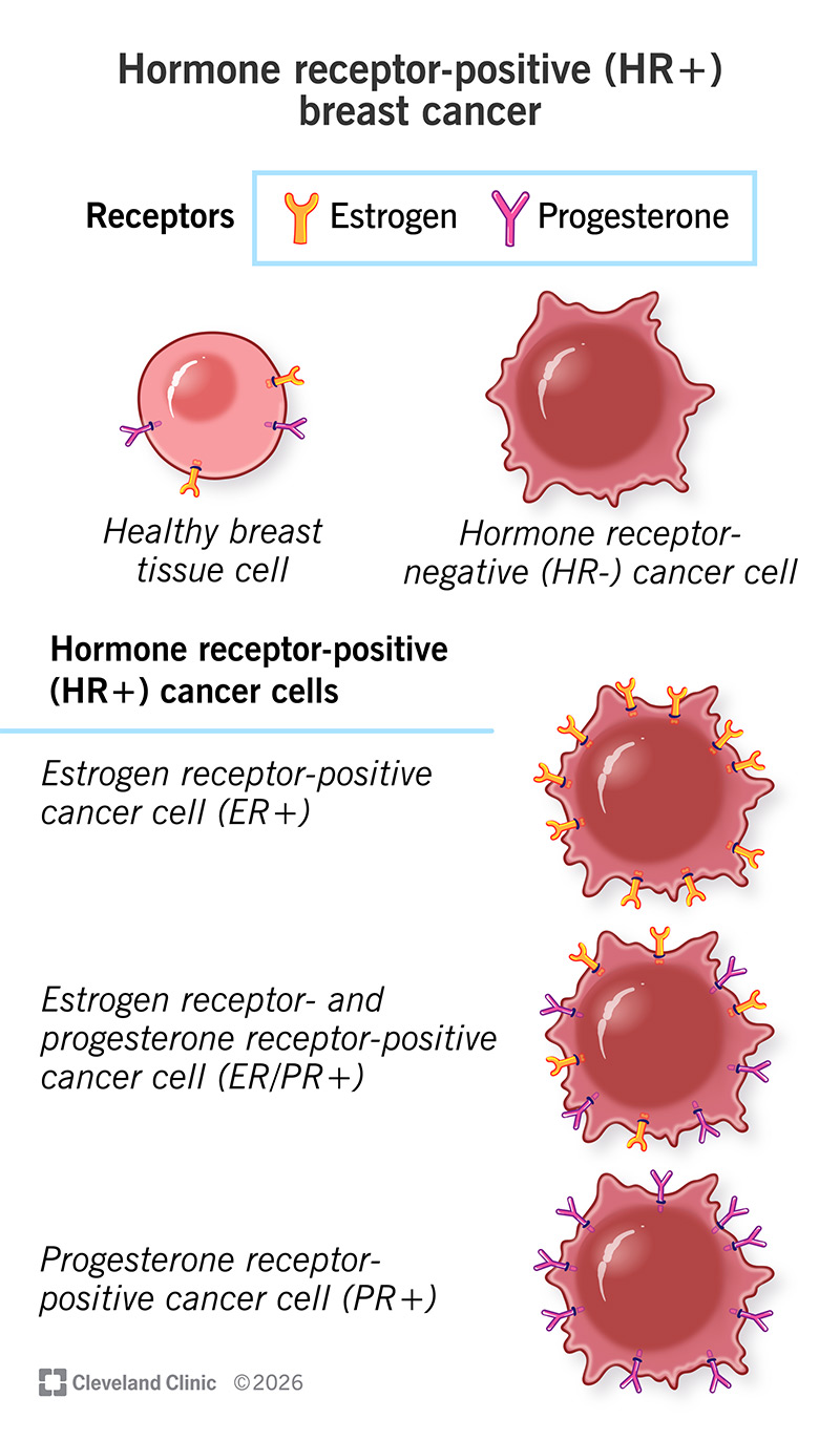 Cancer cells with no hormone receptors versus cancer cells with receptors for estrogen, progesterone and both (ER/PR+)