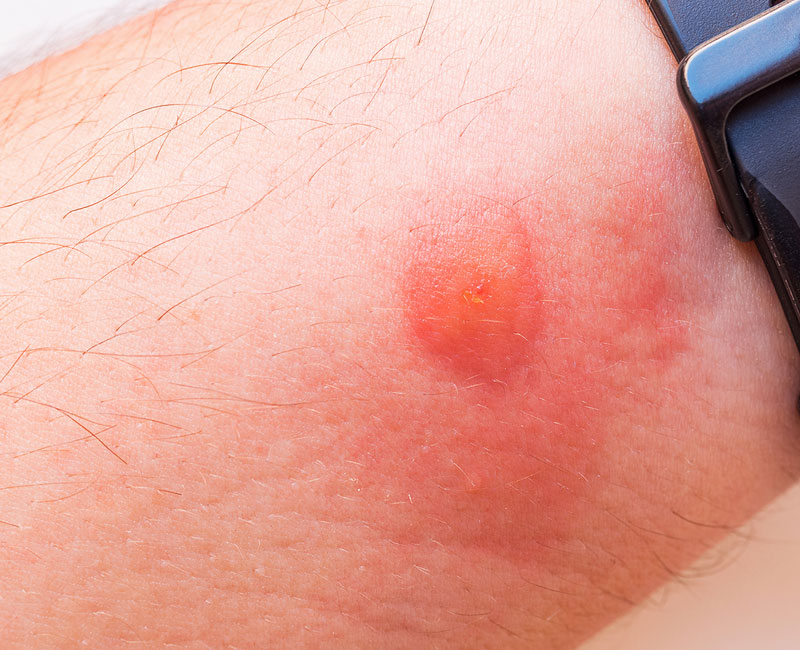 Close-up of horsefly bite on light skin. It looks like a red circle with puffiness around it.