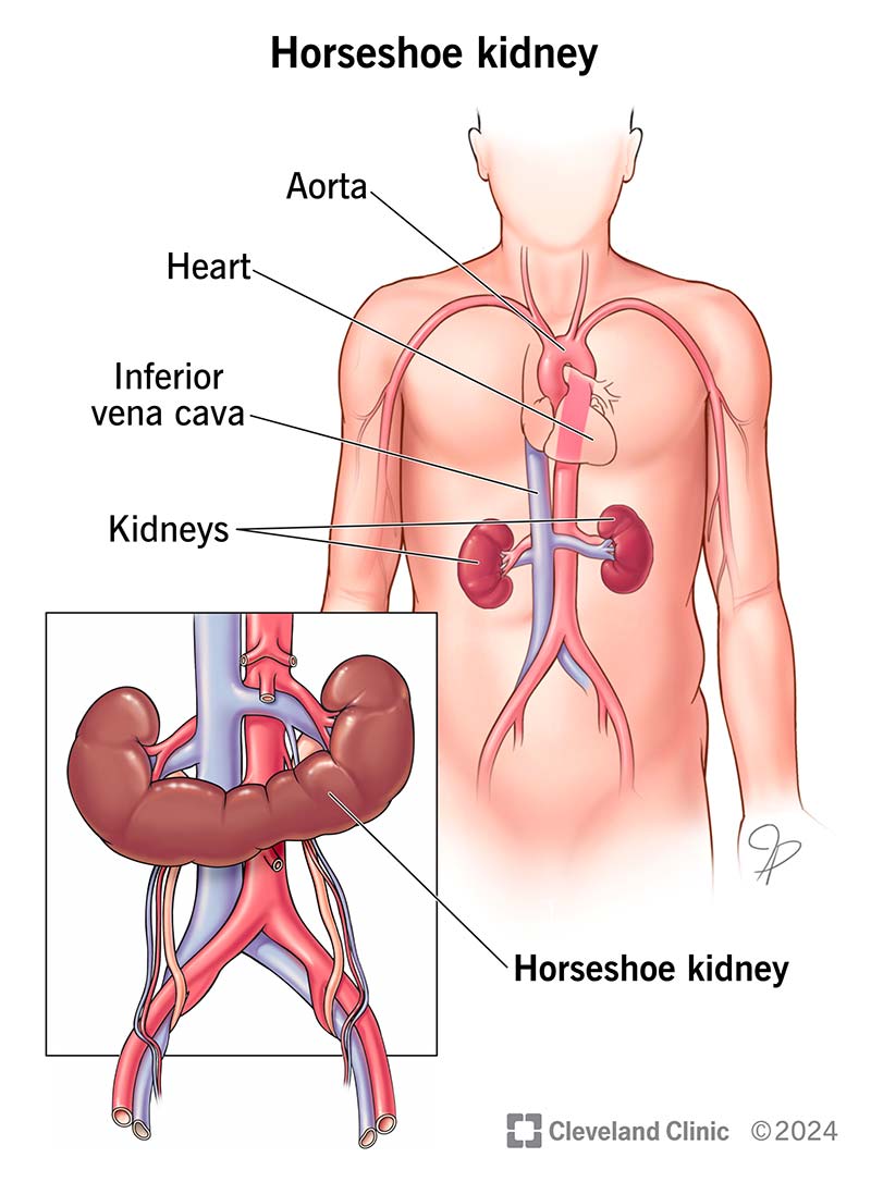 A horseshoe kidney sits lower in your pelvis, closer to the front of your body.
