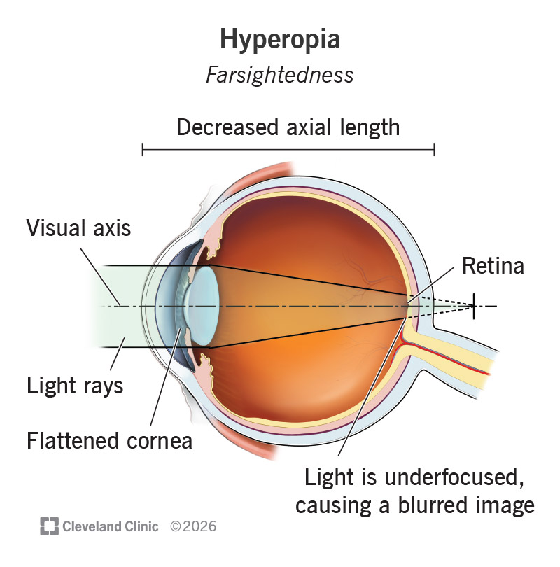 Hyperopia in an eye with labeled anatomy