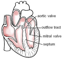 Hypertrophic Cardiomyopathy | Cleveland Clinic: Health Library