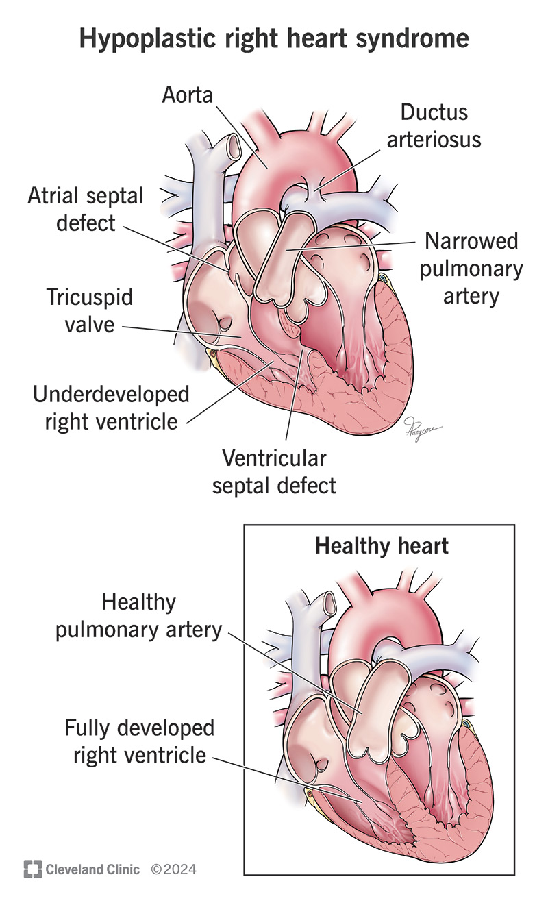 The differences between a healthy heart and one with hypoplastic right heart syndrome