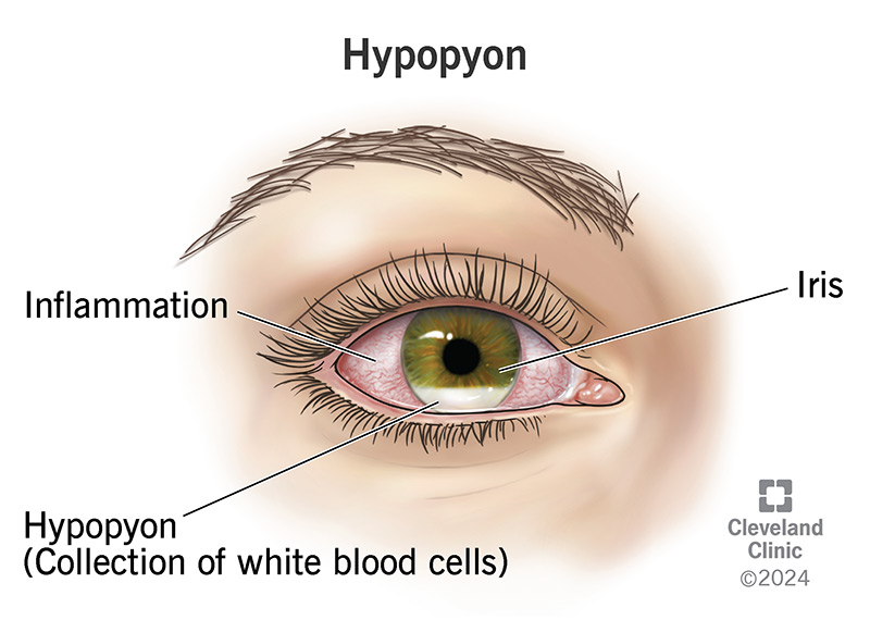 Hypopyons are collections of white blood cells trapped in between layers of your eye.