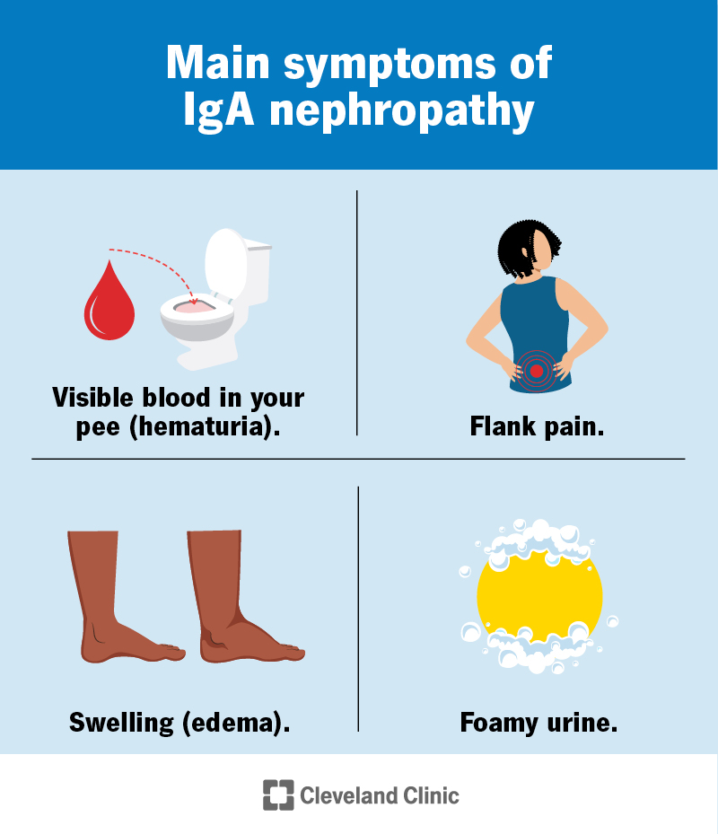 Common IgA nephropathy symptoms include flank pain, swelling, hematuria and foamy pee