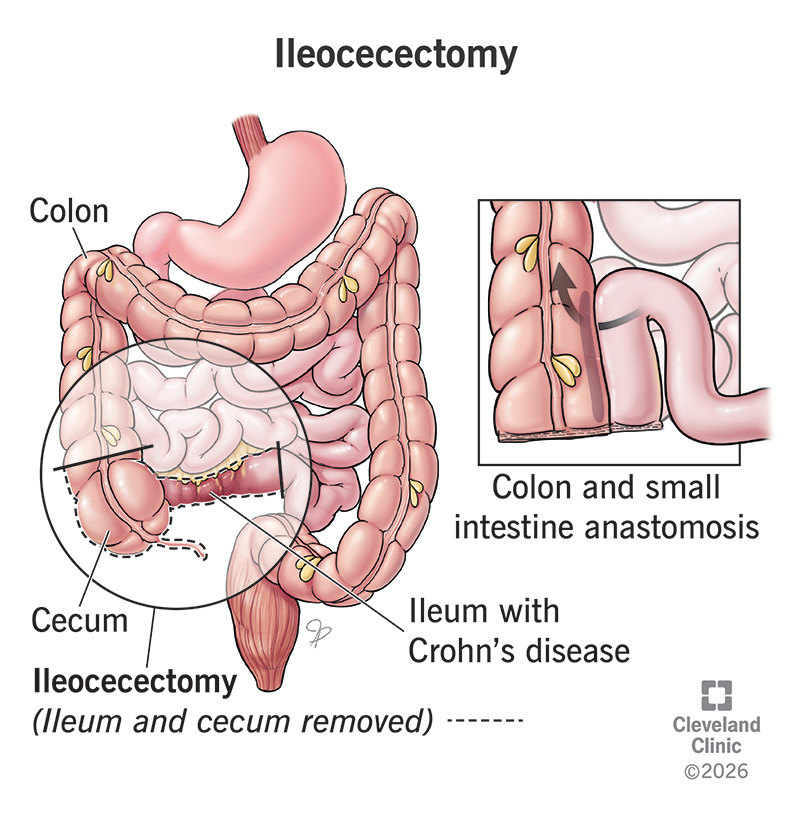 The parts of your intestines that are removed during an ileocecectomy, and how they’re reconnected (anastomosis)