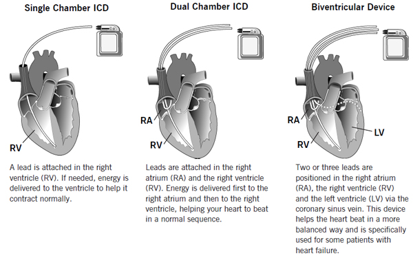 Implantable Cardioverter Defibrillator (ICD) Cleveland clinic
