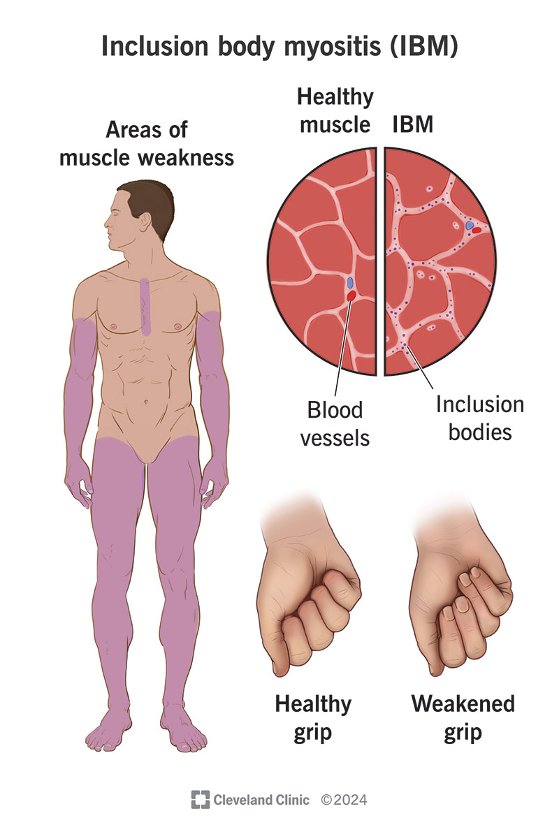 Inclusion body myositis starts in your limbs.
