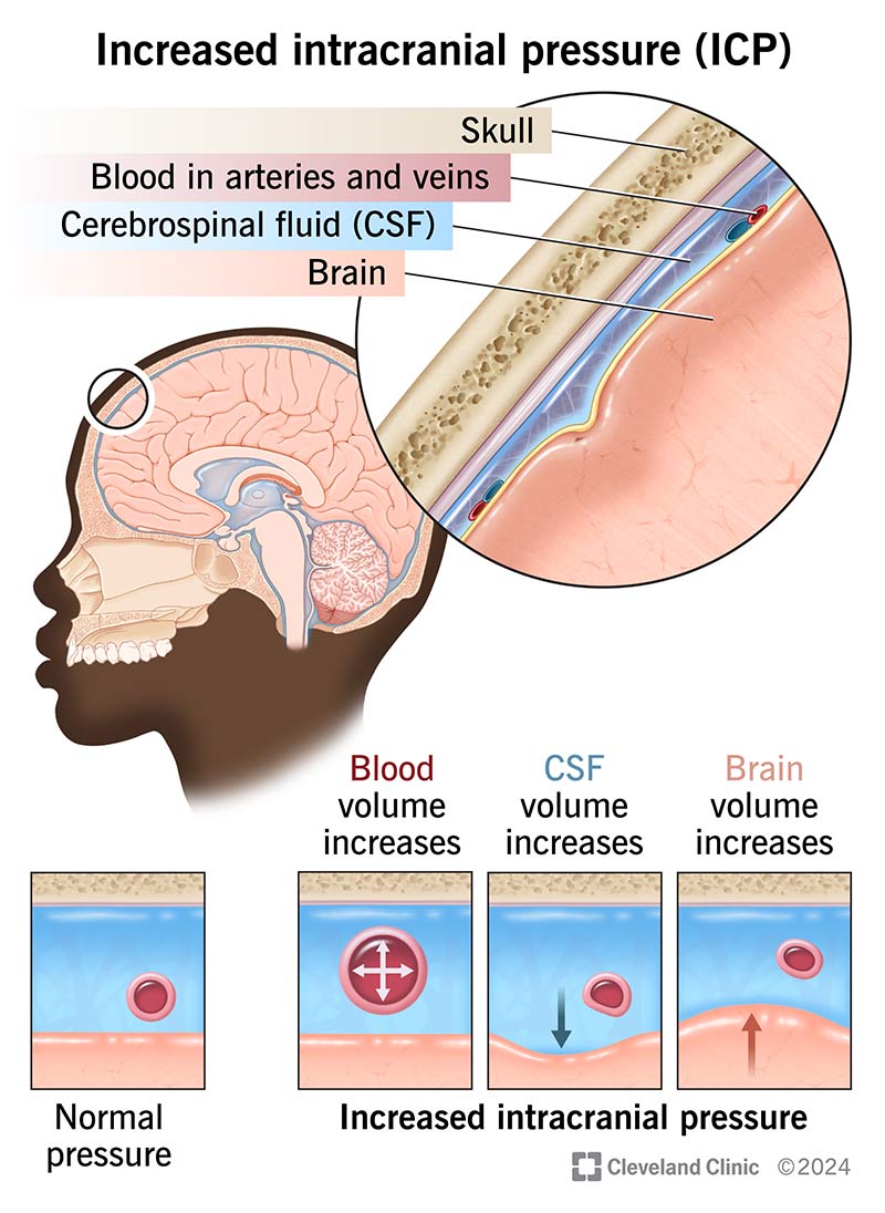 Increased intracranial pressure, with blood volume, CSF volume and brain volume increases