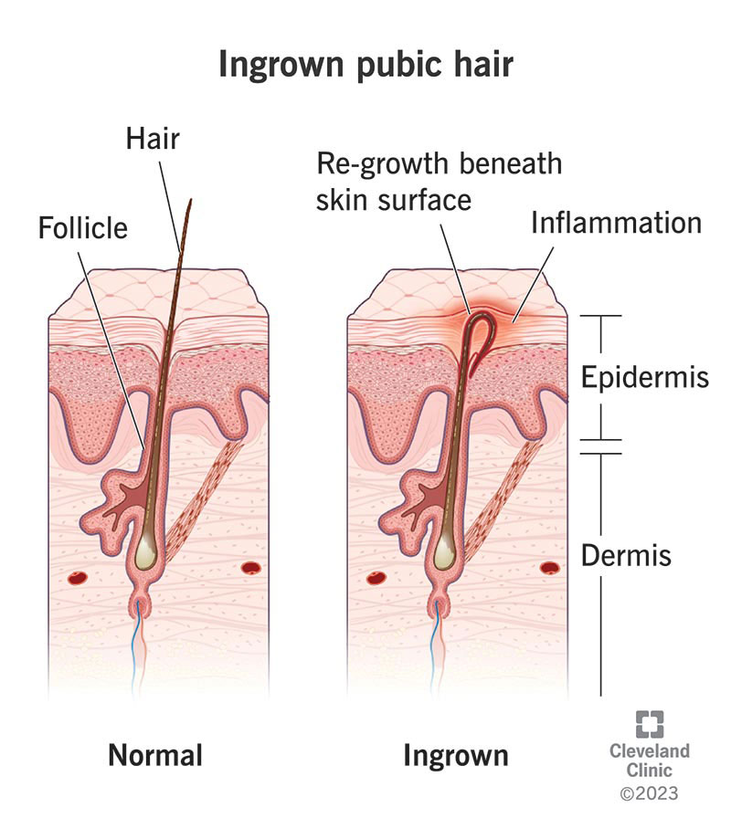 Normal hair growth compared to regrowth beneath the skin surface with ingrown pubic hair