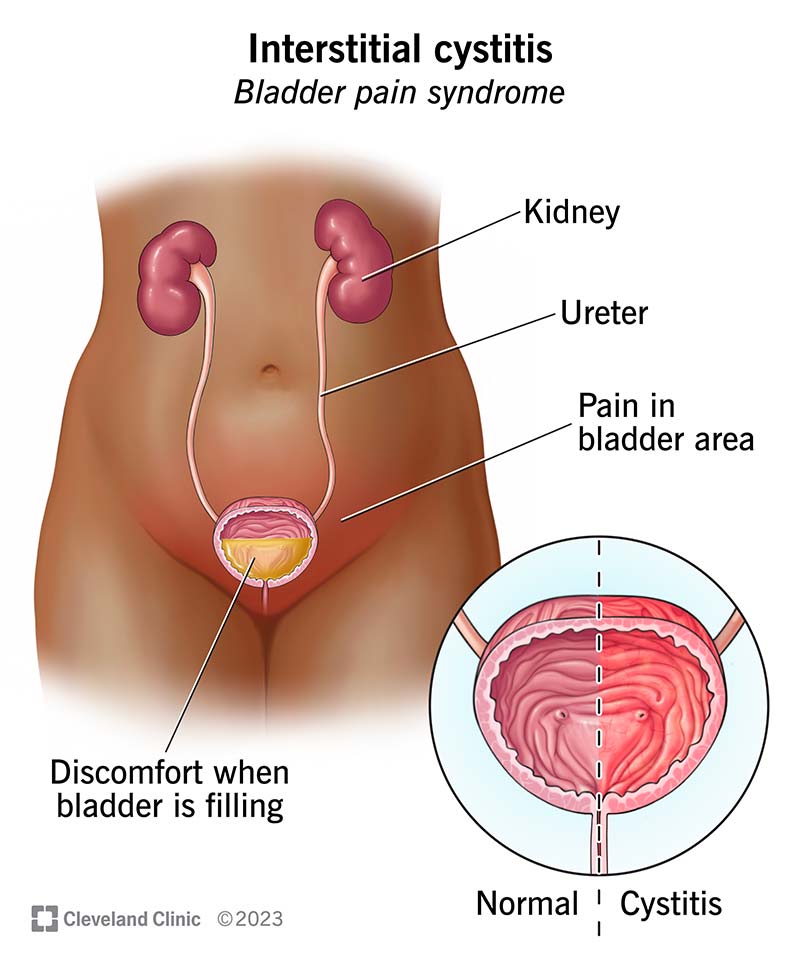 Interstitial cystitis/bladder pain syndrome is an inflamed bladder. It causes discomfort as your bladder fills with pee.