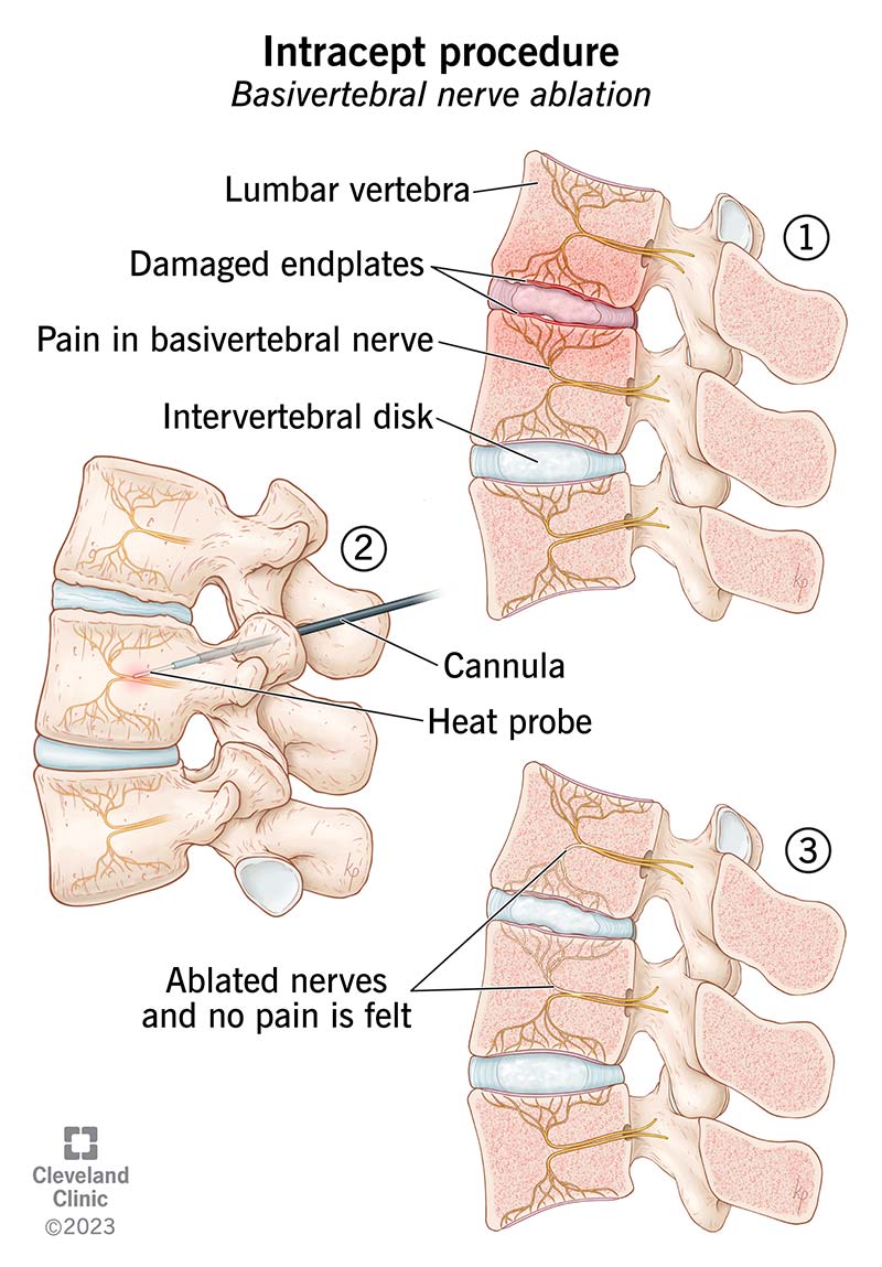 During Intracept procedure, providers use a heat probe to ablate the basivertebral nerve and disrupt pain signals.