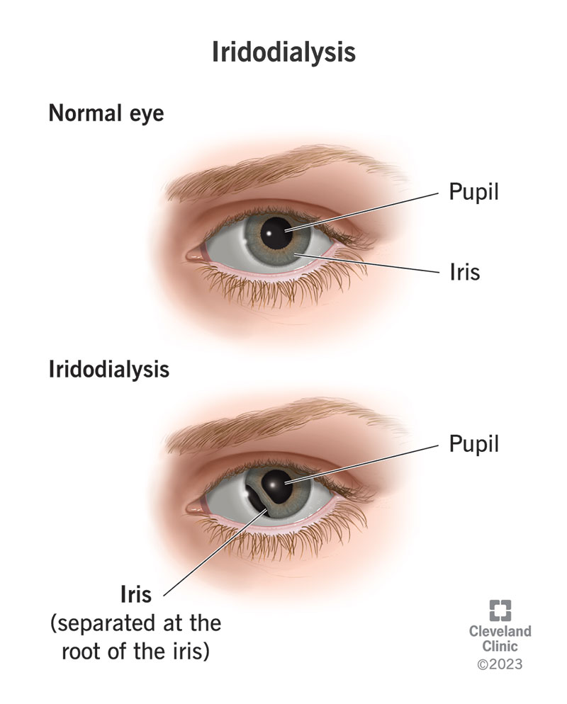 Iridodialysis means that your iris has separated from the ciliary body of your eye instead of being attached.