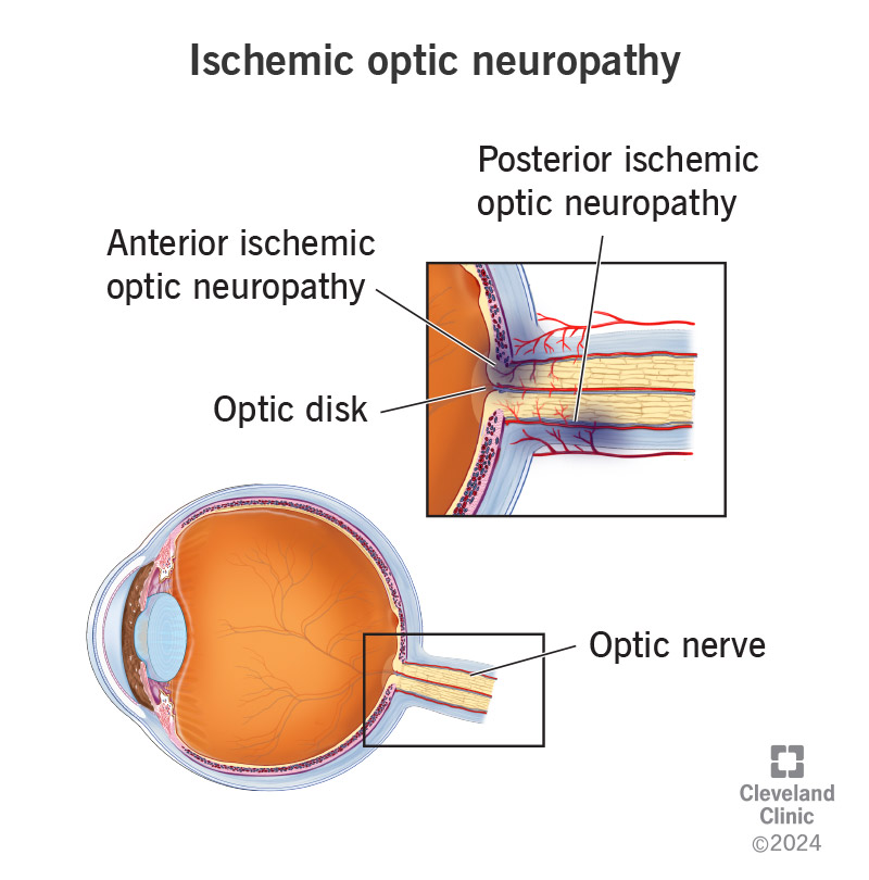 Lack of blood flow causes ischemic optic neuropathy, damaging the anterior (front) and posterior (rear) of the optic nerve
