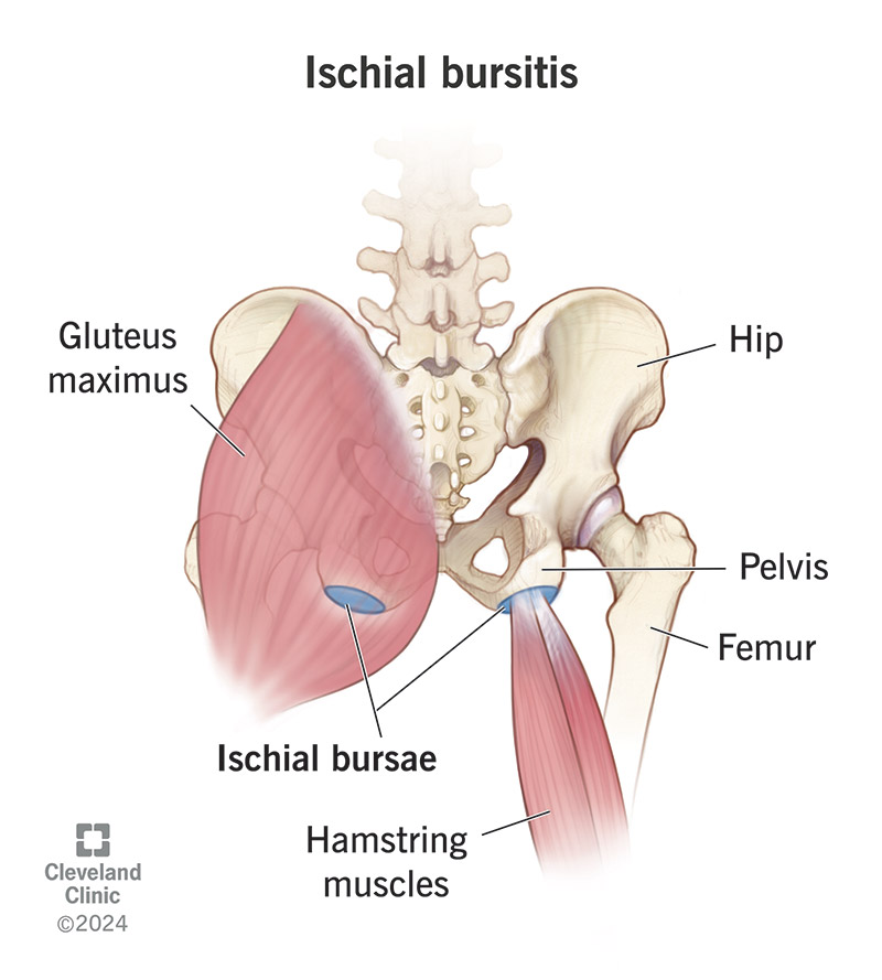 Ischial bursitis occurs in the tissues that cushion your sit bones.