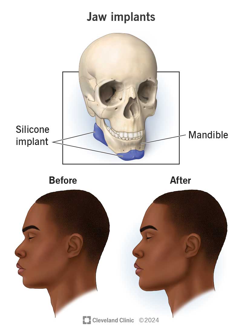 Jaw implants before and after surgery, with an illustration of a human skull with jaw implants.