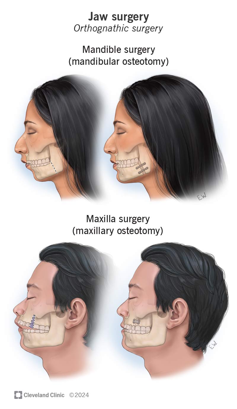 Jaw surgery includes mandibular osteotomy (correction of lower jaw) and maxillary osteotomy (correction of upper jaw)