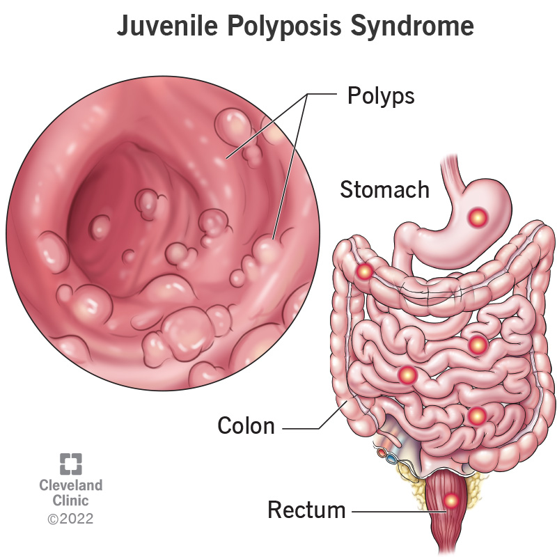An illustration of the stomach, colon and rectum with growths (polyps) caused by juvenile polyposis syndrome.