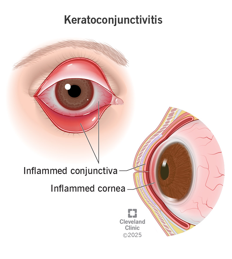 Keratoconjunctivitis is inflammation across the whole surface layer of your eye. That includes your cornea and conjunctiva.