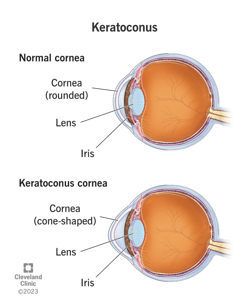 In a normal eye, the dome-shaped cornea protects the lens and iris; with keratoconus, the cornea is shaped like a cone.