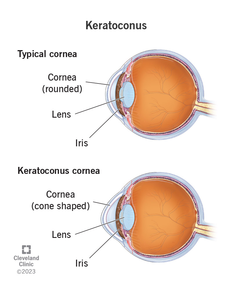 Comparison between typical cornea and one with keratoconus