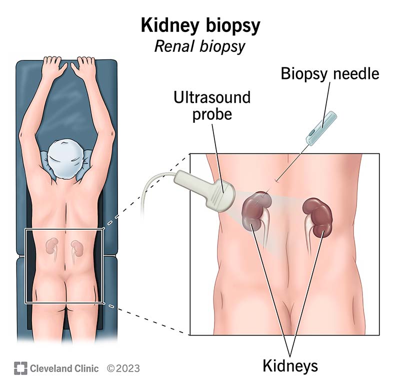 During a kidney biopsy, you’ll lie on your stomach while a provider uses a needle to take a kidney sample.