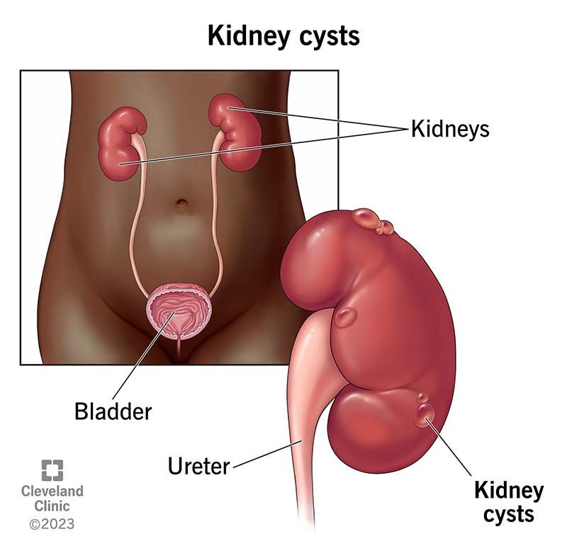 The human body showing the location of the kidney, with the kidney having three fluid-filled cysts on it.
