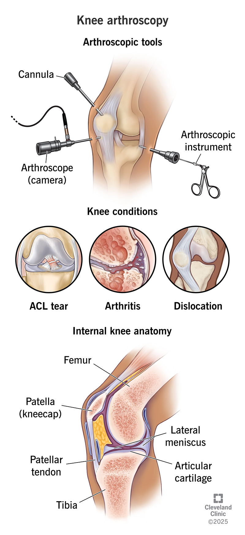 Knee arthroscopy is a minimally invasive surgery