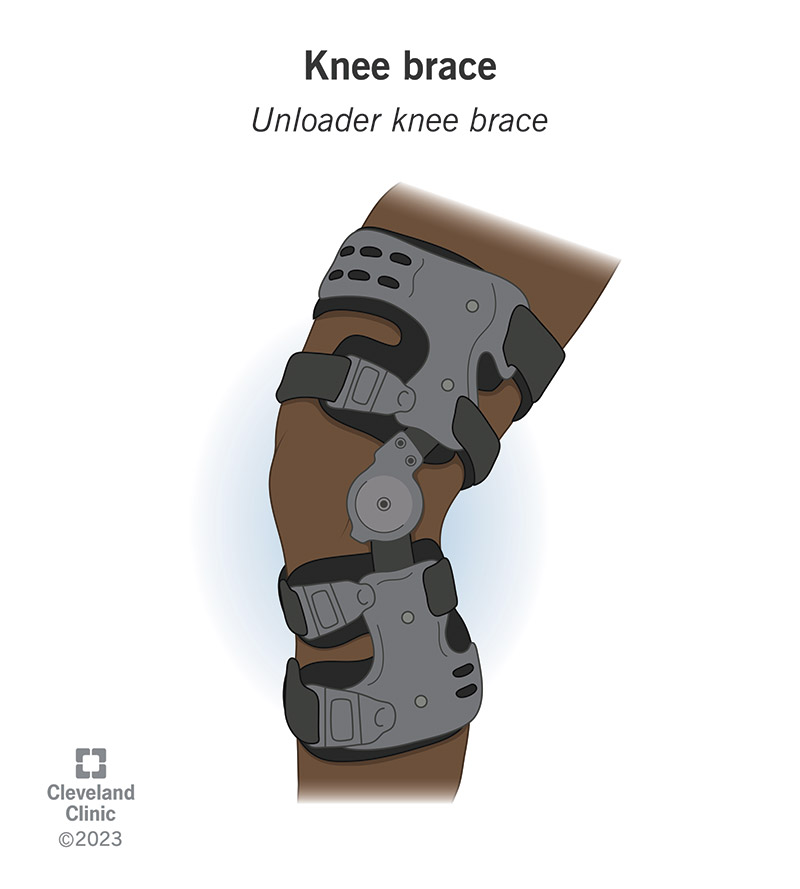 Unloader braces absorb some of your weight and “unload” pressure off your knee.