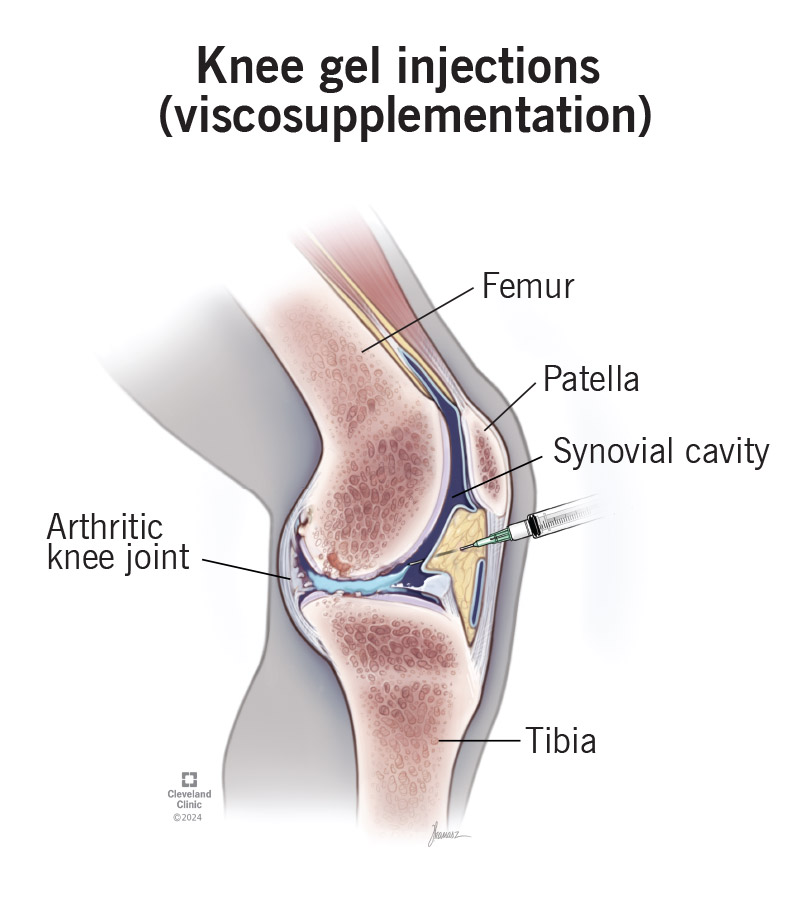 Knee gel injections replace the lost synovial fluid in your knee joint to treat arthritis