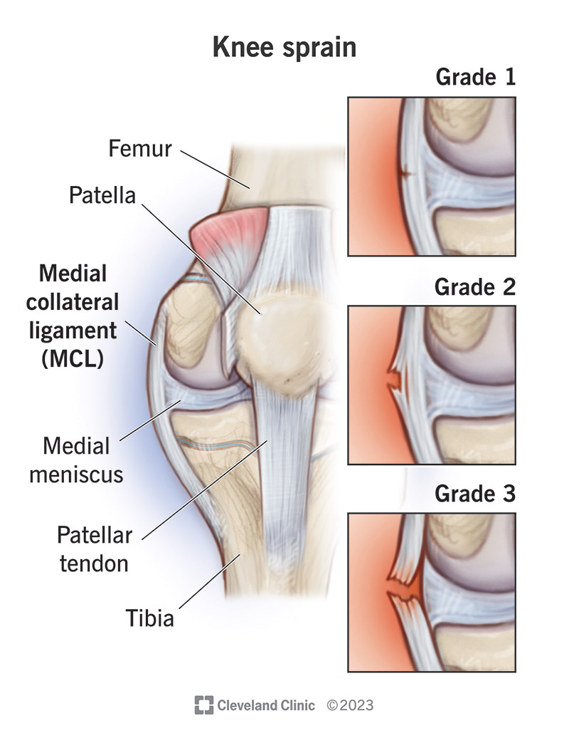 Providers grade knee sprains based on how damaged your knee ligaments are.