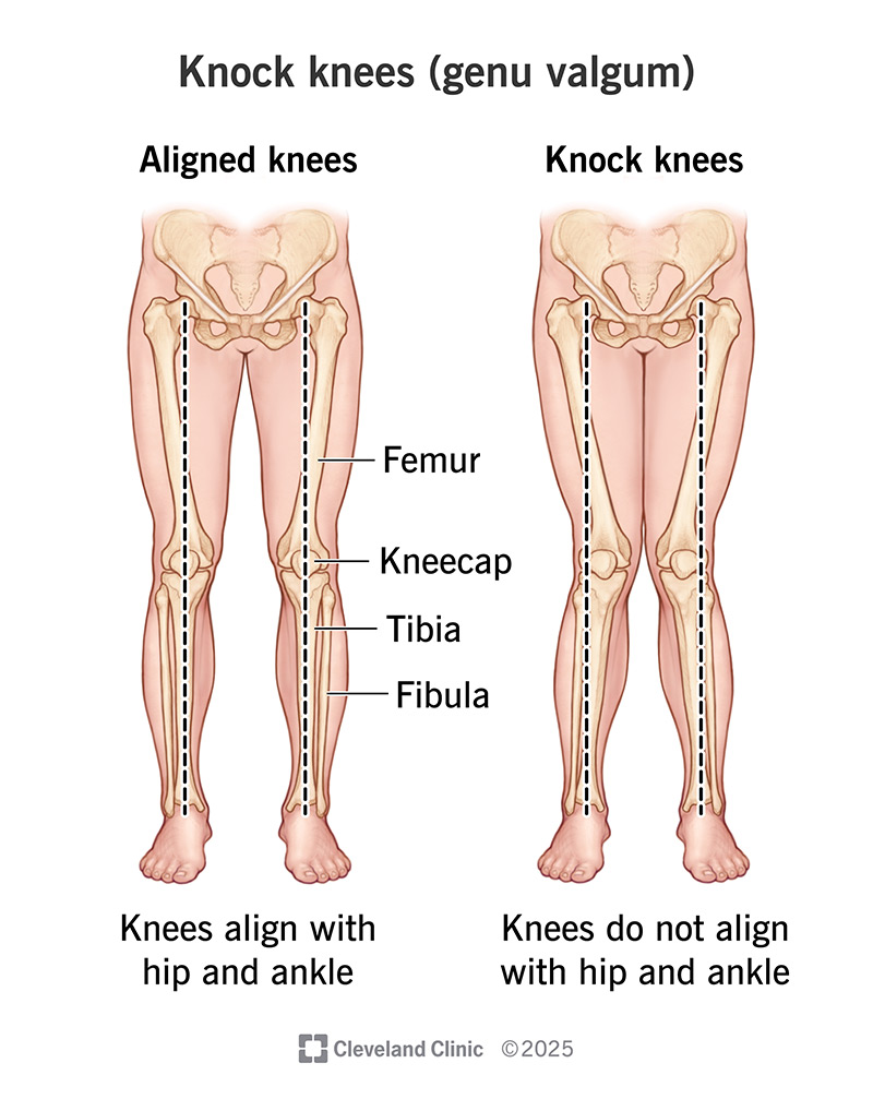 The differences between knock knees and typical knee alignment