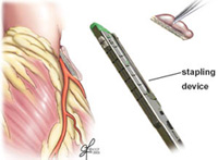 Excision of the Left Atrial Appendage