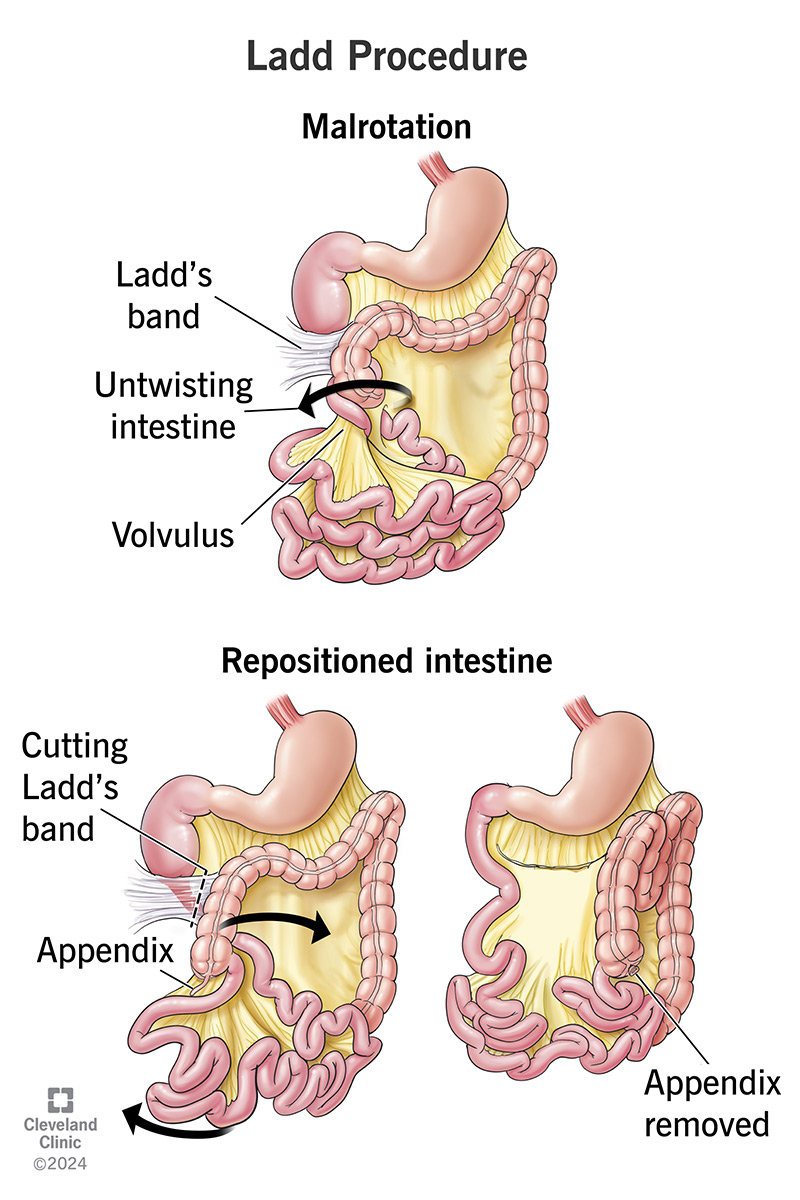 In a Ladd procedure, surgeons smooth twisted intestines (top) and cuts the bands that block babies’ intestines (bottom).