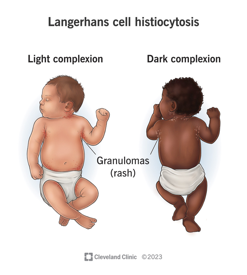 Granulomas caused by Langerhans cell histiocytosis on a light-complexioned baby and dark-complexioned baby.