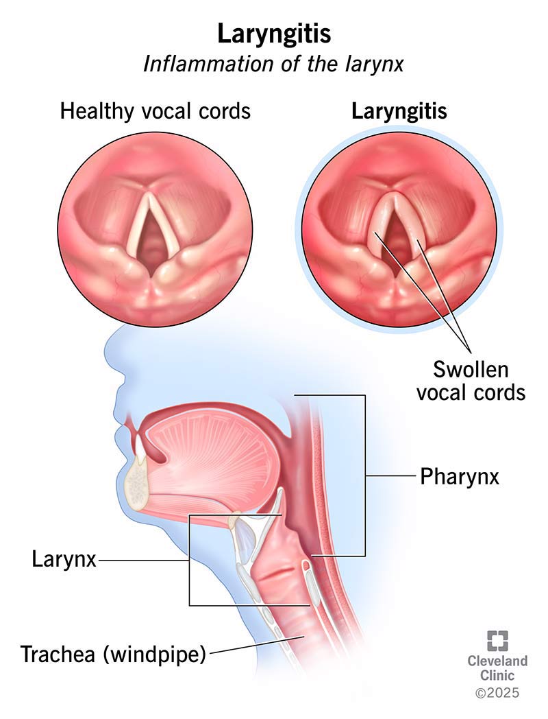 Laryngitis is inflammation in your larynx, also known as your voice box